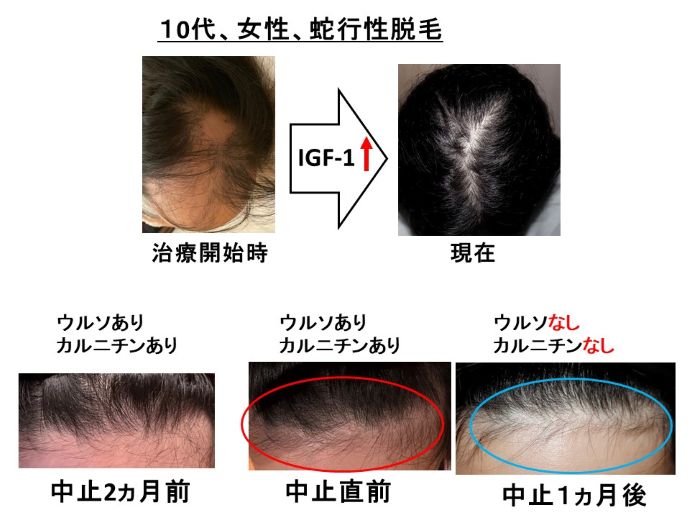 円形脱毛症　病院